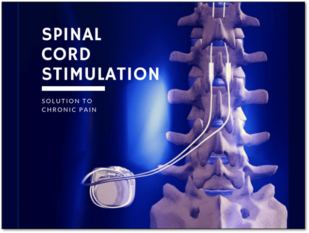 Effectiveness of Spinal Cord Stimulation