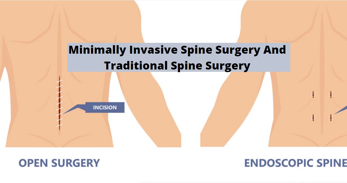 Minimally Invasive Spine Surgery and Traditional Spine Surgery