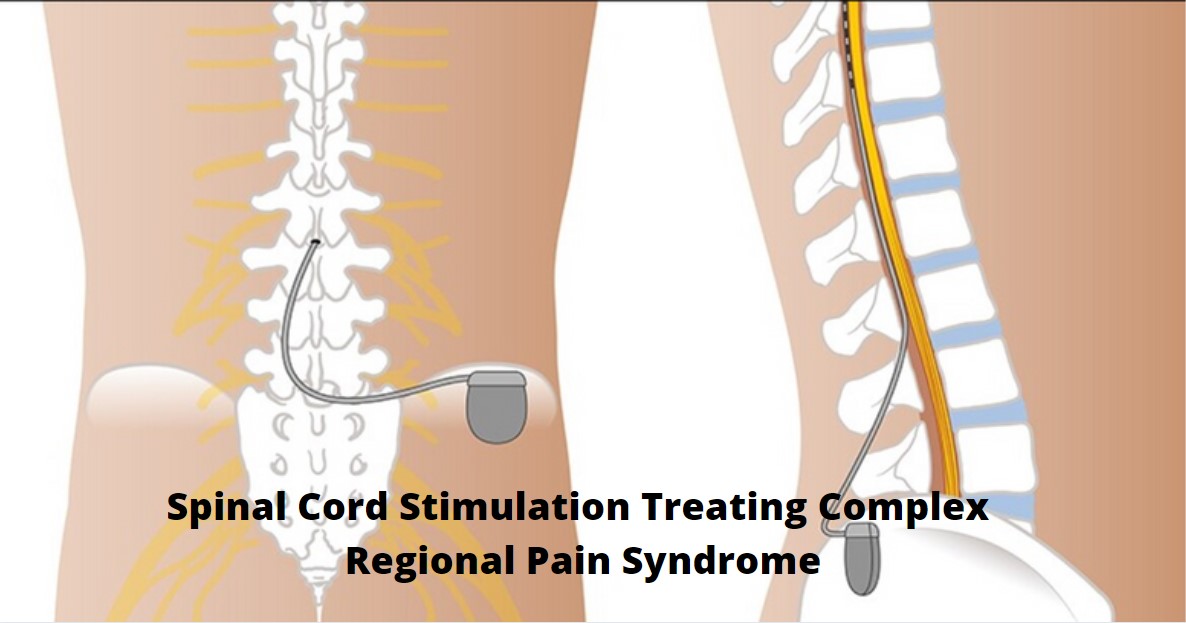 Spinal Cord Stimulation Treating Complex Regional Pain Syndrome